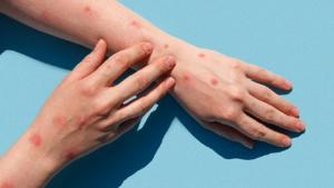 Primul caz de variola maimuței &icirc;n Rom&acirc;nia, &icirc;n București