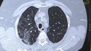 Important! Platformă unică &icirc;n Rom&acirc;nia pentru a doua opinie &icirc;n cazul pacienților cu boli pulmonare